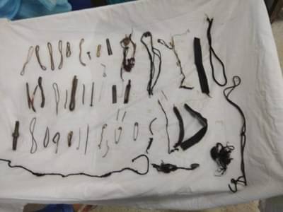 महिलेच्या पोटातून तब्बल दीड किलो वस्तू काढल्या