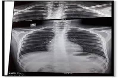 11 वर्षीय मुलाच्या फुफ्फुसात घड्याळाचा सेल, जसलोकमध्ये यशस्वी शस्त्रक्रिया