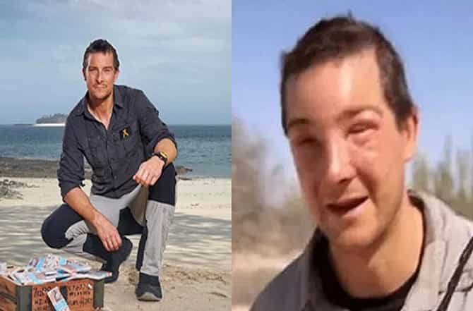 Bear Grylls : बेअर गिल्सवर प्रशांत महासागराजवळील बेटावर हल्ला, चेहरा आणि डोळे सुजले