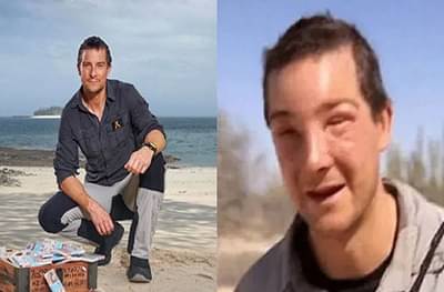 Bear Grylls : बेअर गिल्सवर प्रशांत महासागराजवळील बेटावर हल्ला, चेहरा आणि डोळे सुजले