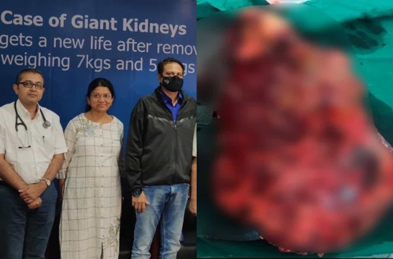 किडनीचं वजन पाहून डॉक्टरही अवाक, भारतातील पहिली दुर्मिळ शस्त्रक्रिया मुंबईत यशस्वी