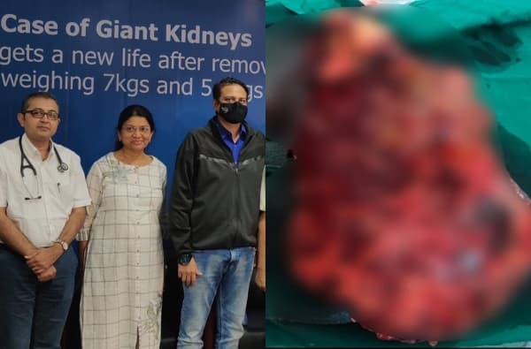 किडनीचं वजन पाहून डॉक्टरही अवाक, भारतातील पहिली दुर्मिळ शस्त्रक्रिया मुंबईत यशस्वी