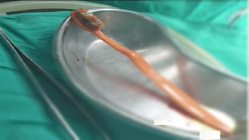 औरंगाबादेत तरुणाने टूथब्रश गिळला, शस्त्रक्रियेनंतर जीवदान