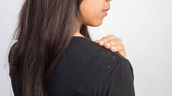 Hair Care | हिवाळ्याच्या दिवसांत कोंड्याच्या समस्येने हैराण? ‘हे’ घरगुती उपचार नक्की ट्राय करा!