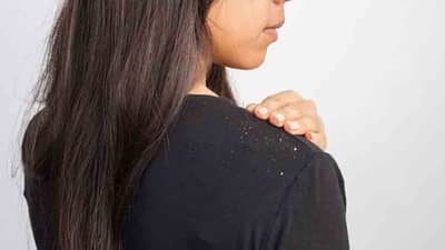 Hair Care | केसांमध्ये कोंड्याची समस्या? मग ‘हे’ घरगुती उपाय नक्की ट्राय करा!