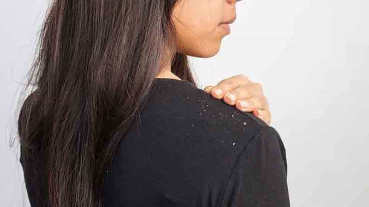 Hair Care | केसांमध्ये कोंड्याची समस्या? मग ‘हे’ घरगुती उपाय नक्की ट्राय करा!