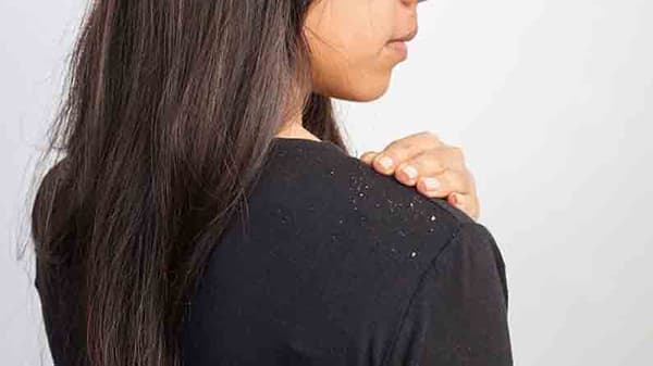 Hair care : कोंड्यामुळे त्रस्त आहात?; मग दूध आणि ओट्सचा हेअर मास्क ट्राय कराच!