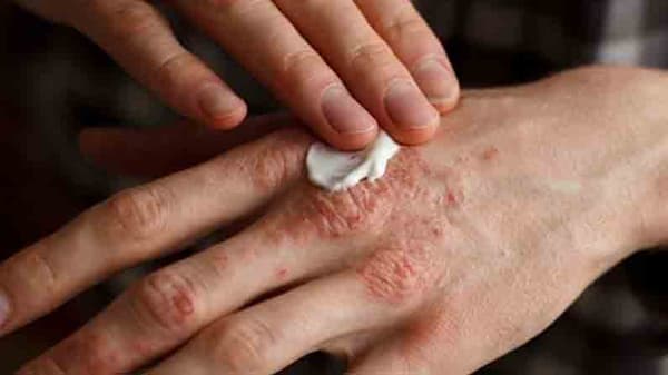 Eczema | ‘एक्झिमा’कडे दुर्लक्ष कराल तर त्वचा होईल खराब, धोका टाळण्यासाठी करा ‘हे’ उपाय!