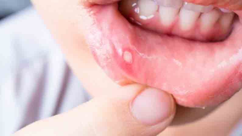 Mouth Ulcer | तोंडाच्या अल्सरने त्रस्त आहात? मग हे घरगुती उपचार नक्की ट्राय करा!