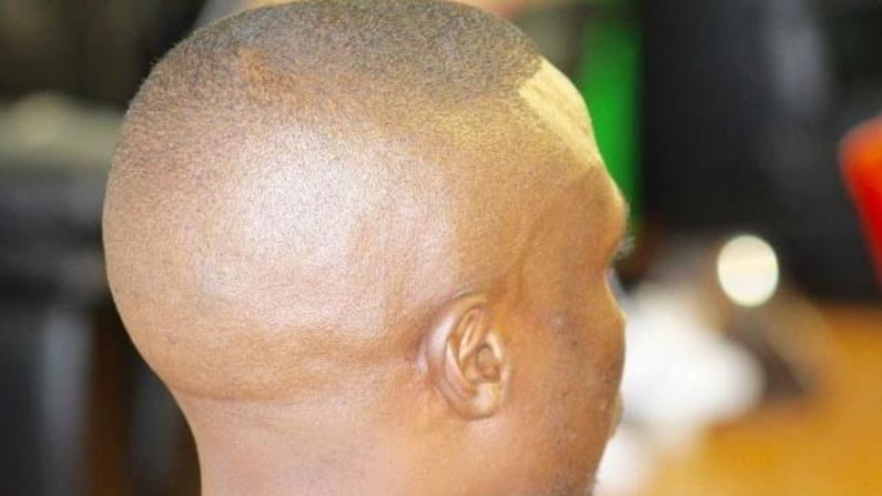 Baldness | गळलेले केस परत येतील, टक्कल पडण्याच्या समस्येपासून सुटका मिळणार, थायलंडच्या शास्त्रज्ञांचा दावा