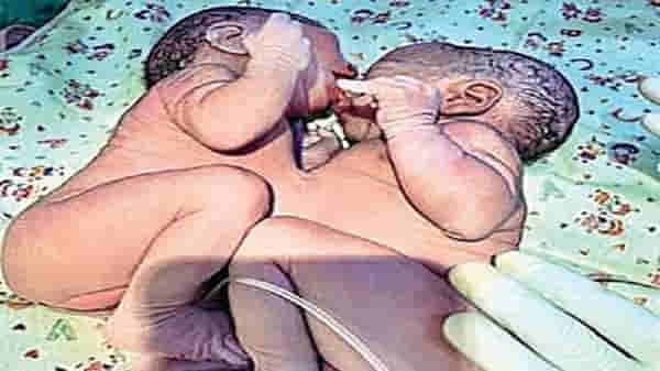 Special Story : पुन्हा एका सयामी जुळ्यांना स्वतंत्र आयुष्य, वाडिया रुग्णालयात चौथी यशस्वी शस्त्रक्रिया