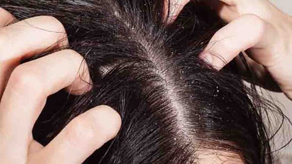 डोक्यातील कोंड्यामुळे त्रस्त आहात? मग ‘या’ सोप्या आयुर्वेदिक टिप्स नक्की ट्राय करा !