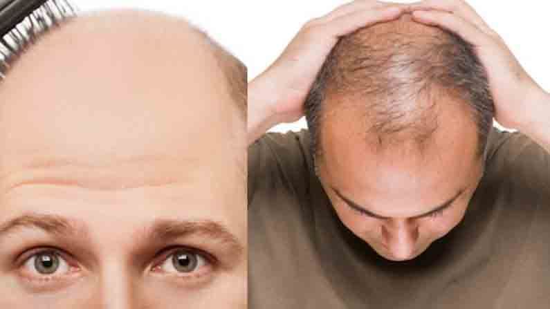 Study | वाढत्या वयानुसार केस गळतीची समस्या सगळ्यांनाच, मग केवळ पुरुषांनाच का पडते ‘टक्कल’?