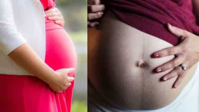 Caesarean Mark | सिझेरिअनच्या खुणा जात नाहीयत? मग, ‘हे’ घरगुती उपाय नक्की ट्राय करा!