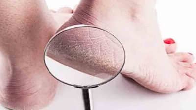 Health Care | थंड तळवे, पिवळी नखे, पायांमध्ये दिसणारे ‘हे’ बदल असू शकतात आजारांचे लक्षण!