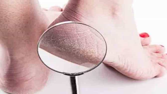 Health Care | थंड तळवे, पिवळी नखे, पायांमध्ये दिसणारे ‘हे’ बदल असू शकतात आजारांचे लक्षण!