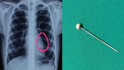 10 वर्षाच्या मुलीने 2 वर्षांपूर्वी गिळलेली पिन फुफ्फुसातून काढण्यात डॉक्टरांना यश