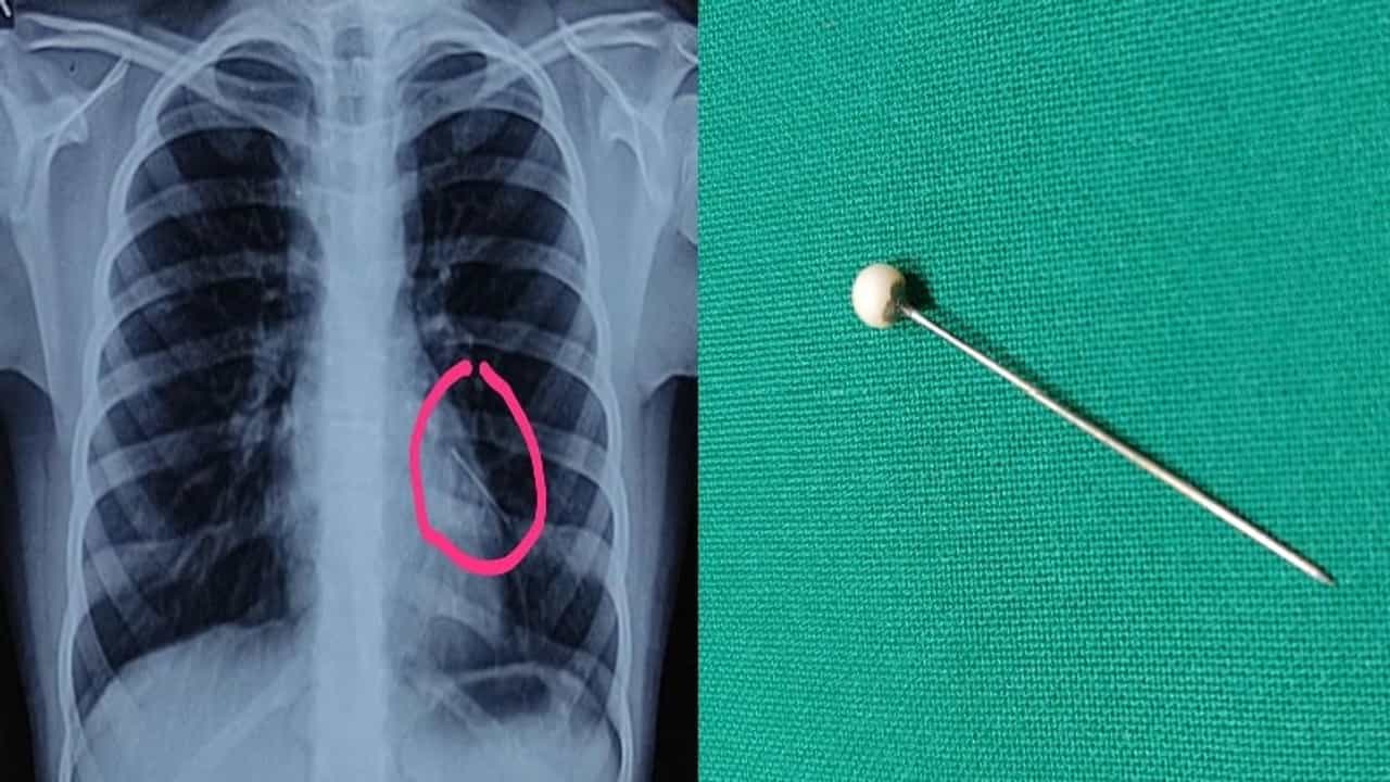 10 वर्षाच्या मुलीने 2 वर्षांपूर्वी गिळलेली पिन फुफ्फुसातून काढण्यात डॉक्टरांना यश