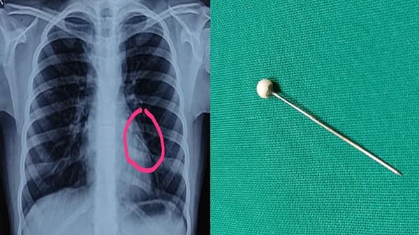 10 वर्षाच्या मुलीने 2 वर्षांपूर्वी गिळलेली पिन फुफ्फुसातून काढण्यात डॉक्टरांना यश