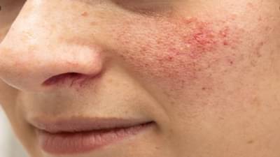 चेहऱ्यावरील लालसरपणा कमी करण्यासाठी हे घरगुती उपाय करा !