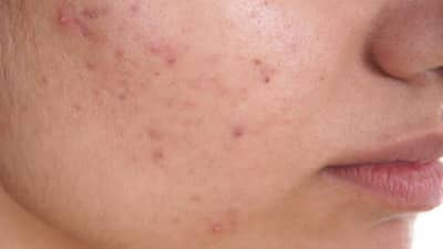 चेहऱ्यावरील मुरुमामुळे त्रस्त आहात? मग हे पदार्थ खाणे टाळाच...