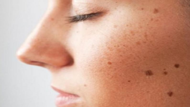 Skin Care : चेहऱ्यावरील काळे डाग दूर करण्यासाठी 'हे' घरगुती उपाय एकदा नक्की करून पाहा, वाचा!