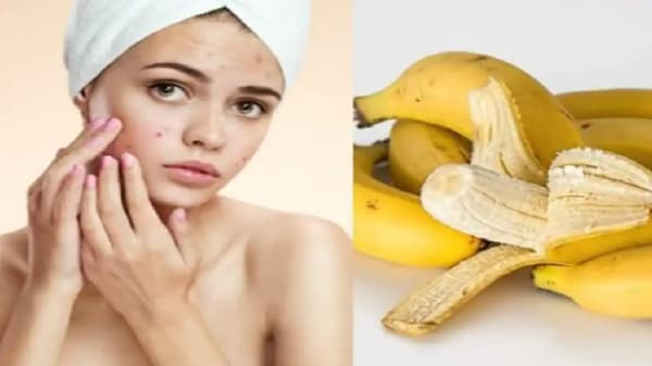 केळीच्या सालीचा हा फेसपॅक चेहऱ्याला लावा आणि सुंदर त्वचा मिळवा !
