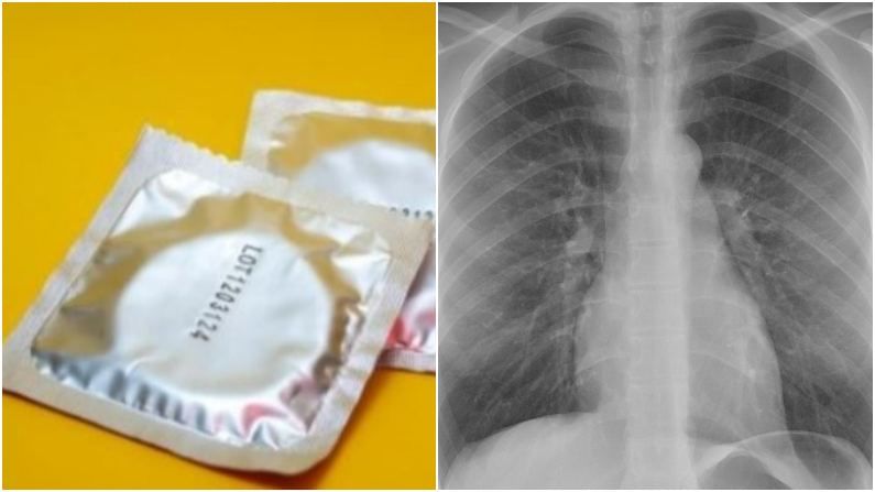Condom in Woman lung : 27 वर्षीय शिक्षिकेला आधी टीबीचा संशय, तपासणीत फुफ्फुसात कंडोम निघाला, डॉक्टरही अवाक