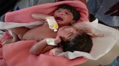 तीन हात, दोन डोकं, ओदिशात जुळ्या मुलींचा जन्म