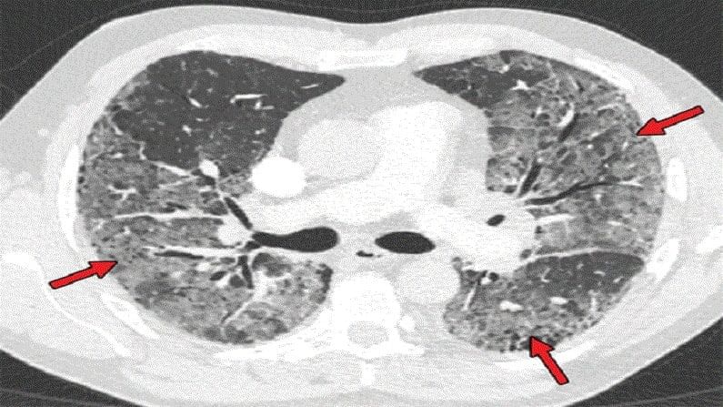 आपल्या फुफ्फुसात किती इन्फेक्शन आहे याची माहिती मिळवण्यासाठी CT Scan केला जातो. त्याद्वारे HRCT स्कोअर पाहिला जातो. त्यानुसार मग कोरोना रुग्णांवर उपचार केला जातो. तसंच त्याला गोळ्या-औषधं दिली जातात. मात्र, तुम्हाला कोरोनाची सौम्य लक्षणं असतील तर CT Scan करण्याची गरज नसल्याचं AIIMS कडून सांगण्यात आलं आहे. 