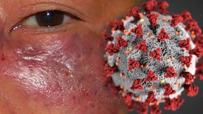 Mucormycosis : गुजरातमध्ये 500 कोरोना रुग्णांना म्युकर मायकोसिस, 20 जणांचे डोळे निकामी, तर 10 जणांचा मृत्यू