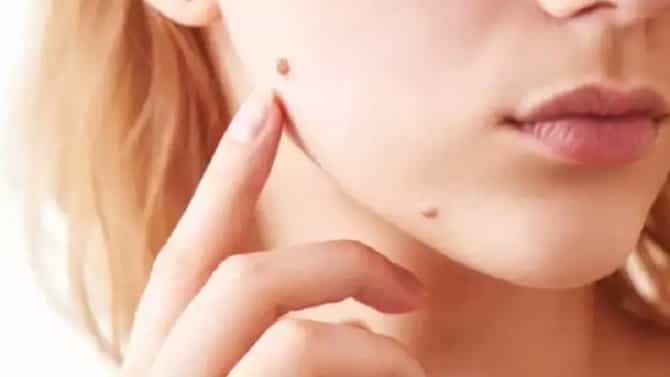 Beauty Tips : चेहर्यावरील नको असलेले तीळ काढून टाकण्यासाठी ‘हे’ घरगुती उपाय नक्की ट्राय करा !