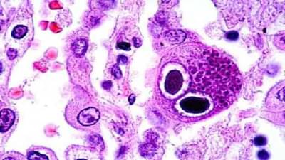 राजीव सातव यांच्या शरीरात आढळलेला सायटोमॅजिलो व्हायरस नेमका काय? धोका कुणाला?