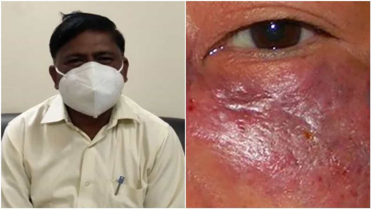 अहमदनगरमध्ये कोरोनानंतर म्युकर मायकोसिसचं थैमान, तब्बल 61 जणांना संसर्ग, औषधांसाठी नातेवाईकांची वणवण