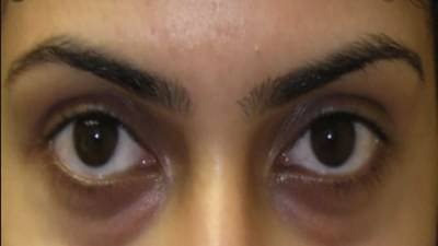 डोळ्यांखालील डार्क सर्कलमुळे त्रस्त आहात? मग, या टिप्स नक्की फाॅलो करा