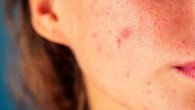 चेहऱ्यावरील पिंपल्सची समस्या दूर करण्यासाठी हे 3 फेसपॅक फायदेशीर, वाचा!