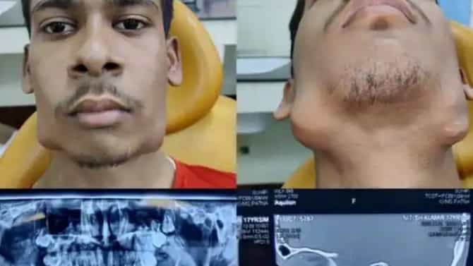 17 वर्षांच्या तरुणाच्या जबड्यात ट्यूमर, डॉक्टरांनी तोंडातून 82 दात बाहेर काढले