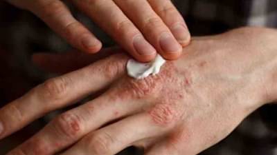 Health Care : फंगल इन्फेक्शनची समस्या दूर करण्यासाठी लसूण अत्यंत फायदेशीर!