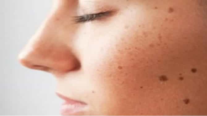 Skin Care : चेहऱ्यावरील नको असलेले तीळ काढण्यासाठी हे घरगुती उपाय करा!