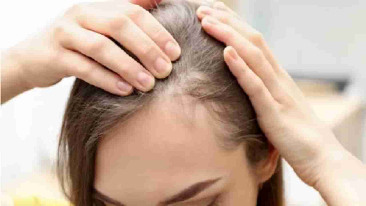 Baldness or Hair Loss Problem: ऐन तारुण्यात डोक्यावरचे केस जात आहेत?; हे उपाय कराच!