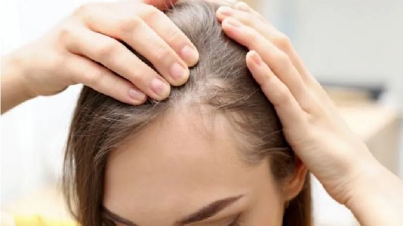 Baldness or Hair Loss Problem: ऐन तारुण्यात डोक्यावरचे केस जात आहेत?; 'हे' उपाय कराच!