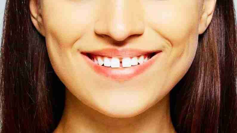 आपल्या दातातील गॅप काय संकेत देतो? जाणून घ्या मनोरंजक माहिती