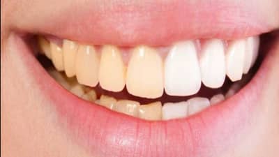 लोकांनो, दात सांभाळा, लवकर दात पडल्यास स्मरणशक्ती कमकुवत होते; वाचा सर्व्हे काय सांगतो