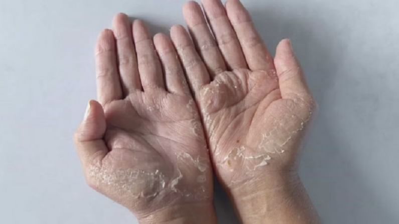 Skin Care : पावसाळ्यात हातापायांची काळजी घेण्यासाठी 'हे' घरगुती उपाय करा!