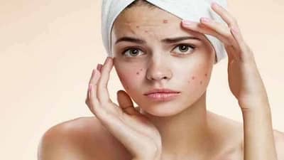 Monsoon Skincare Tips : पावसाळ्यात मुरुमांच्या समस्येवर मात करण्याशाठी फॉलो करा या टिप्स