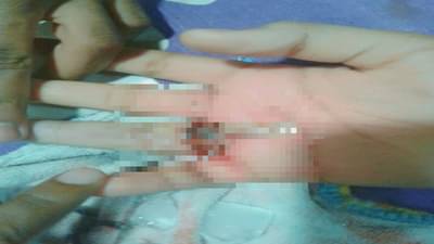 बोटात अडकलेली अंगठी काढण्यासाठी धारदार ग्राईंडरचा वापर, ठाण्यातील रुग्णालयाचा विचित्रप्रकार