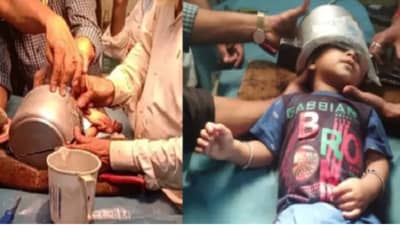 चिमुकल्याच्या डोक्यात कुकर अडकला, अनेक तासांची मेहनत, शेवटी मशीनने कुकर कापला!