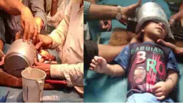 चिमुकल्याच्या डोक्यात कुकर अडकला, अनेक तासांची मेहनत, शेवटी मशीनने कुकर कापला!