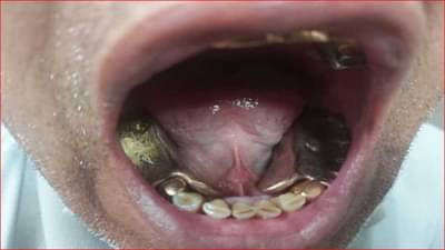 दाताच्या खाचेत गोल्ड प्लेटस बसवल्या, तोंडात सोन्याची चेन कोंबली, कस्टमच्या अधिकाऱ्यांनी पकडलं 45 लाखांचं सोनं