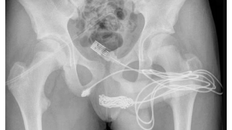 15 वर्षीय मुलाच्या गुप्तांगात अडकली USB केबल, डॉक्टरांना करावी लागली शस्त्रक्रिया